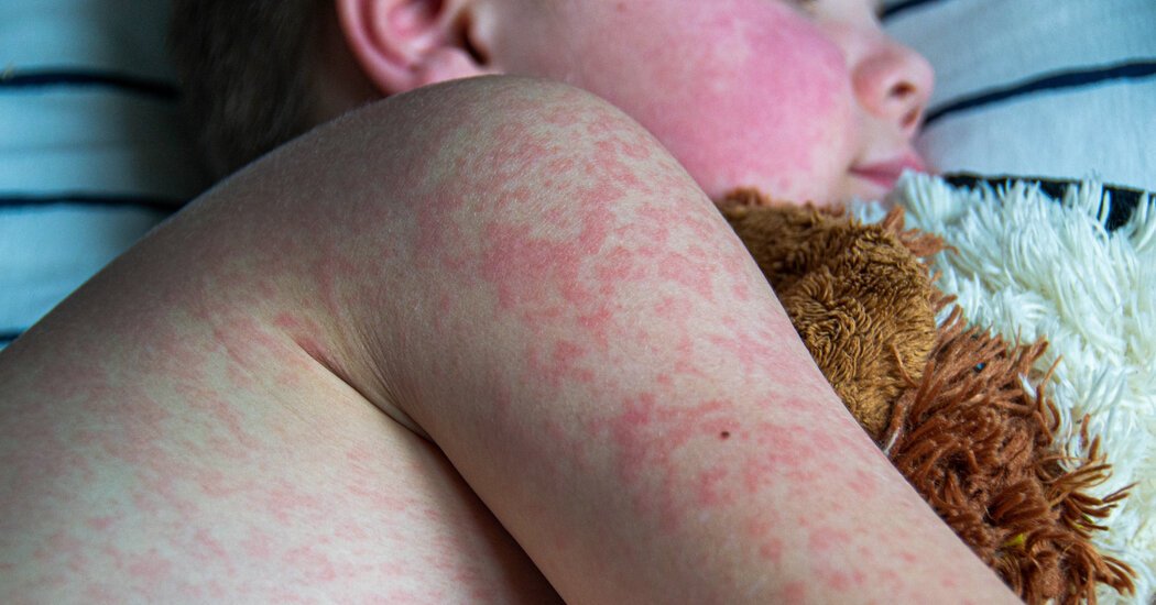 ⚠️ 2025 Measles Outbreak in the Southwest: A Wake-Up Call for the U.S. Health System